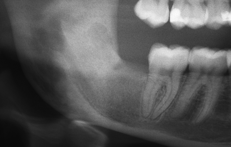 after-cyst-wisdom-tooth